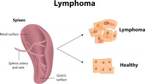 Ảnh 4 của Lymphoma